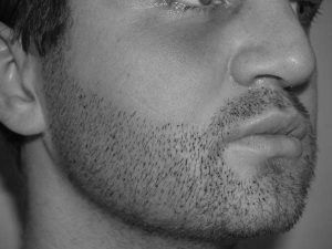implant barbe